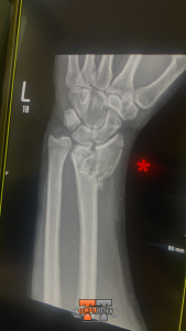 Wrist Injury X-ray showing previous injury before returning to strength training